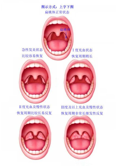 扁桃体炎_郑州民生耳鼻喉医院